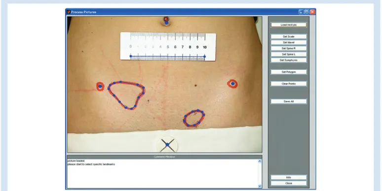 Fig 2 Tool to define the anaesthetized areas and the specific reference points (landmarks)