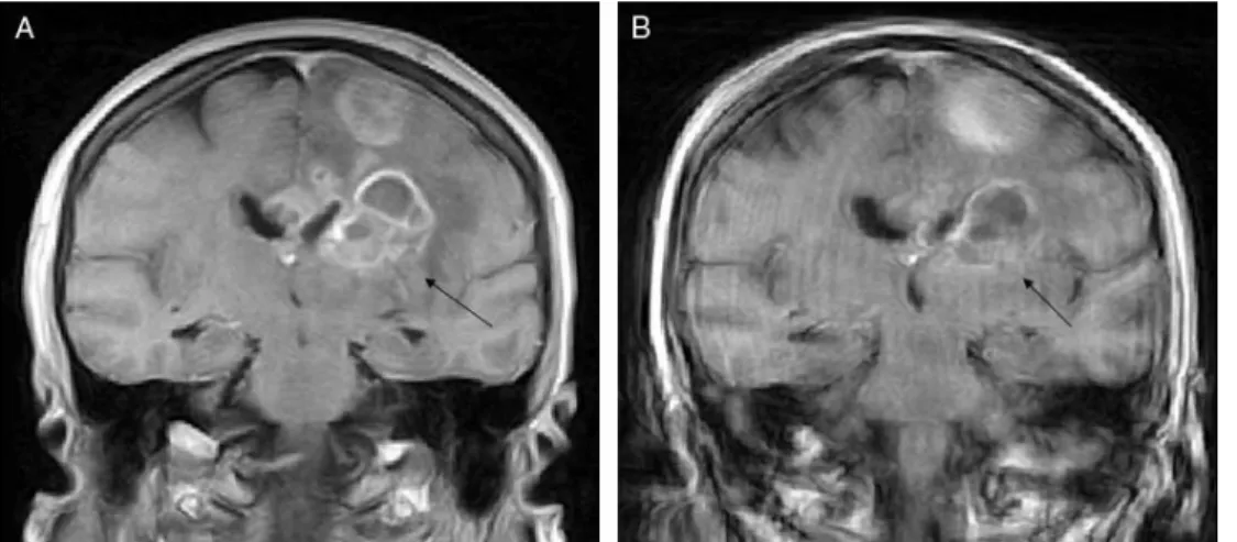 Fig. 3 MRI coronal reconstruction of T1-weighted contrast-enhanced images at similar rostro-caudal levels