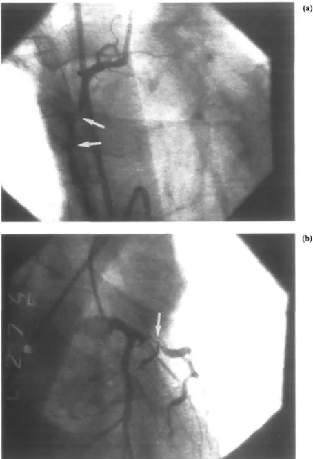 Figure 1 (a) 30° right anterior oblique view of the right coronary artery showing the initial high grade tandem stenosis (arrows) at the time of left to right collateral flow, (b) 30° right anterior oblique view with 30° caudal tilt showing severe proximal