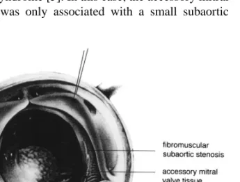 Fig. 2. Final appearance of fibrous obstruction as seen and resected through the mitral valve.
