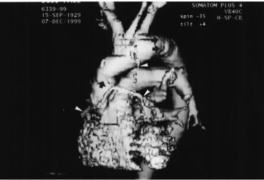 Fig. 1. Postoperative CT scan revealed proximal (arrow) and distal anastomosis with the distal part of the elephant trunk (double arrow) of the homogenous implanted prosthesis as well as the implanted supraaortic vessel patch