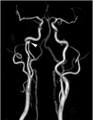 Figure  1:  3D-reconstructed  gadolinium-enhanced  T1-weighted  echo- echo-gradient angio-MRI of a 68-year-old woman showing right extracranial ICA duplication associated with a subcranial aneurysm (arrowhead)