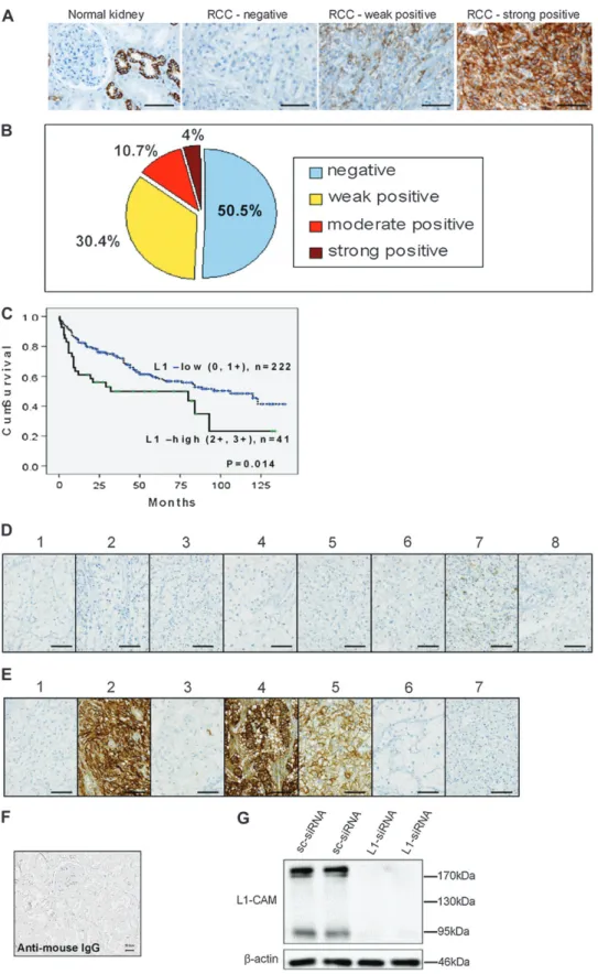 Fig. 1. Expression of L1-CAM in normal kidney and renal cancer on a TMA. (A) Immunohistochemistry images showing the expression of L1-CAM in normal kidney and a representative image of negative, weak positive and strong positive L1-CAM staining in renal ca