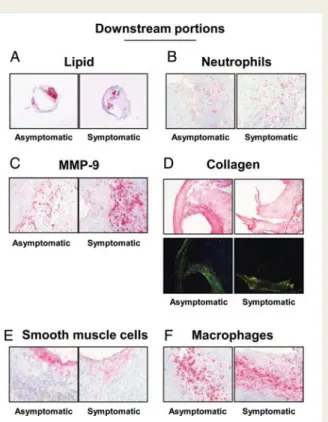 Figure 2 Parameters of plaque vulnerability in downstream portions of carotid plaques