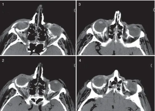 Fig 3 On the four images of this representative CT scan, the spread of the contrast dye can be seen
