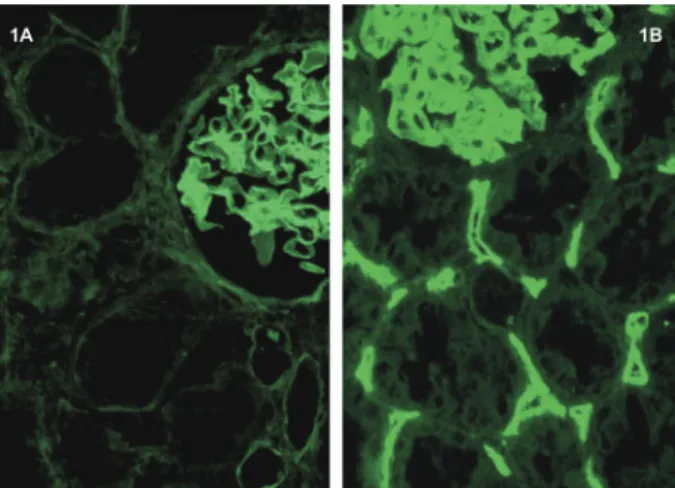 Fig. 1. Expression of C4d of a normal biopsy and a case with humoral rejection as detected by F-IF