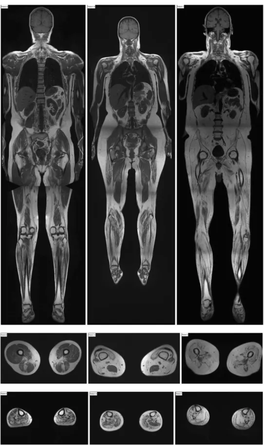 Fig. 3 Whole body MRI scans (T1-weighted images) and transverse sections of upper and lower-limb muscles