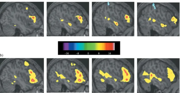 Table 6. Regions of activation in the ASD group for response-naming compared to visual processing task