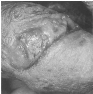 Figure 1. Genital ulcers in a patient with human immunodeficiency virus infection.
