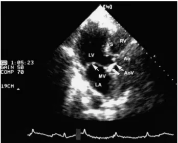 Figure 1. Cardiac apical long axis view. LV, left ventricle;