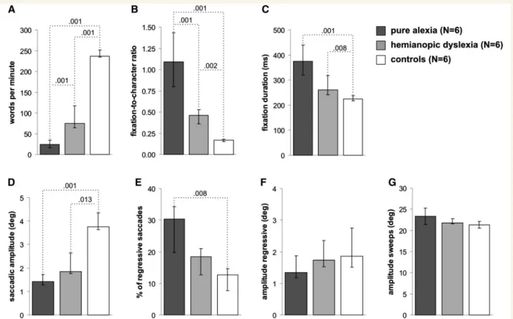 Figure 3 Reading speed and visuo-motor variables. Group-specific medians and interquartile ranges/IQRs are shown for: (A) reading speed; (B) fixation frequency; (C) average fixation duration; (D) amplitude of rightward saccades; (E) percentage of regressio