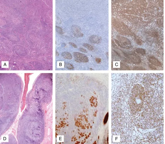 Figure 1 Follicular features in Waldeyer ’ s ring diffuse large B-cell lymphomas (WR DLBCLs)