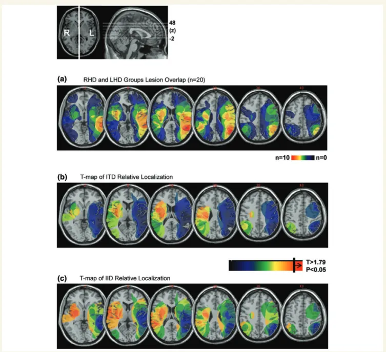 Figure 3 Voxel-based lesion-symptom mapping on the subgroup of 20 patients (L16–L25; R16–R25) show the relationship between localization performance and brain lesions; right hemisphere on the left