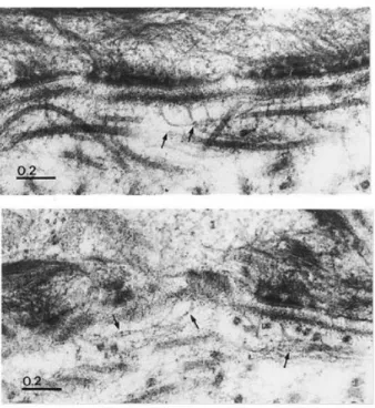 Figure 2. Indirect immunofluorescence staining of control and EBD skin with antibodies to the C-propeptide of procollagen VII