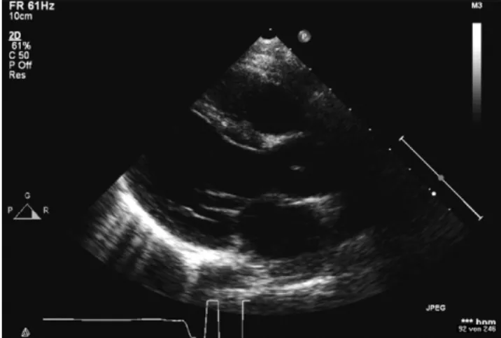 Fig. 3. A trans-esophageal echocardiography image showing the realigned ventricular septum and a harmonious left ventricular outflow 4 years after partial direct VSD closure in TOF.