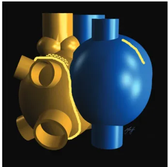Figure 2: (A) Schematic view of an implantable LVAD connected to the left ventricle (inﬂow) and the aorta (outﬂow)