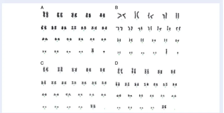 Figure 5 Karyotype. (A) Control line HS293 frozen with 10% DMSO in SR medium show a normal male karyotype 46 XY