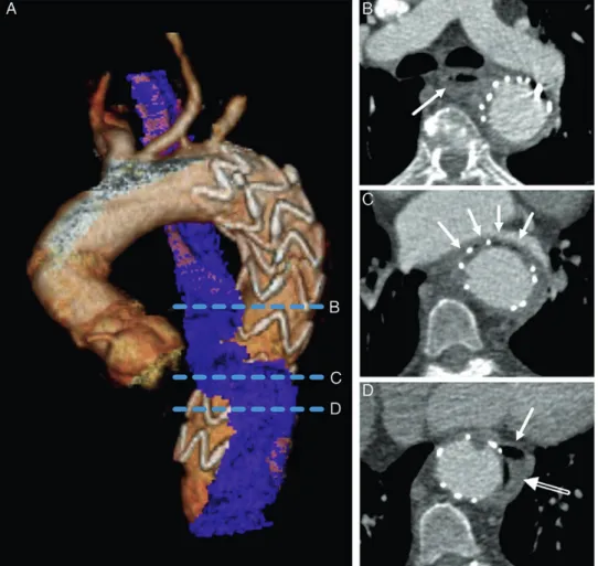 Figure 1: CT of a 58-year old female with AOF after TEVAR for acute complicated type B aortic dissection