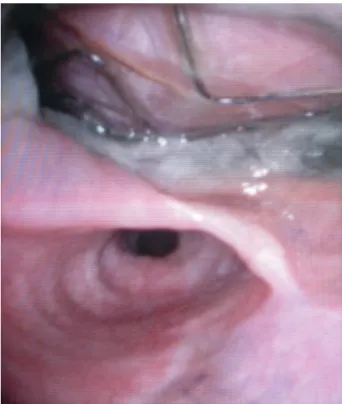 Figure 4: (A). Intraoperative view after oesophagectomy and orthotopic recon- recon-struction with a bovine pericardial neoaorta