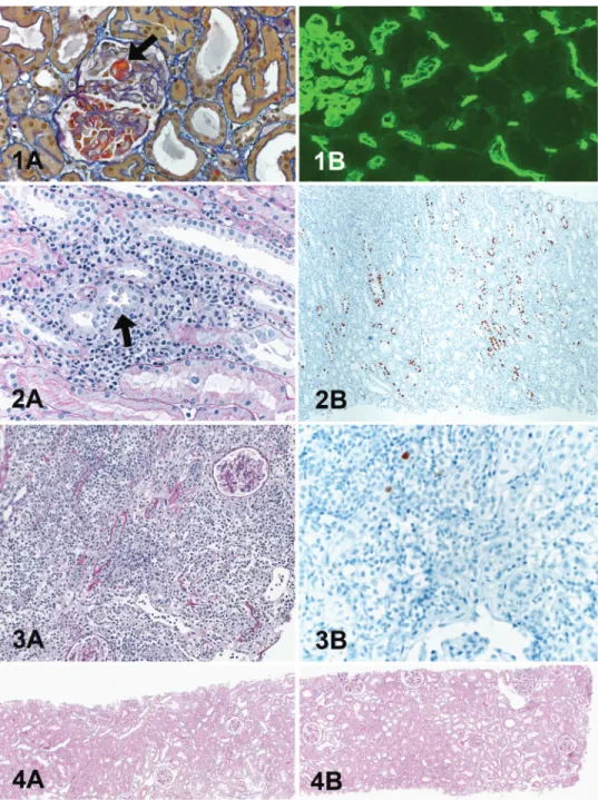 Fig. 2. Allograft histology graded according to the Banff classification [16] and a recently proposed semi-quantitative assessment for PVAN [1]