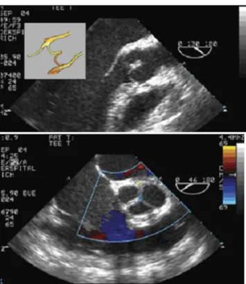 Fig. 4. TEE diastolic frames in long (top) and short (bottom) axes. The restored curve of the leaflets with a broad coaptation segment is well illustrated in the long-axis view (insert)