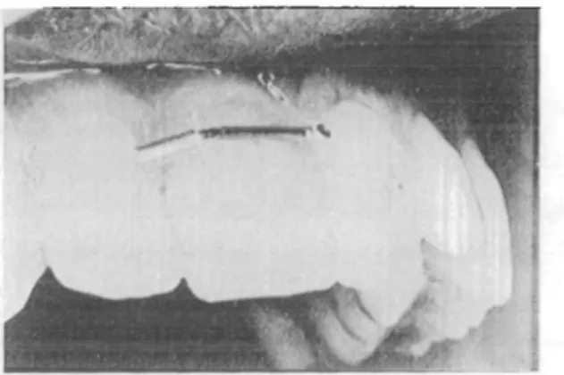 Figure 4 Placement of the electrodes for the recording of lip muscle activity.