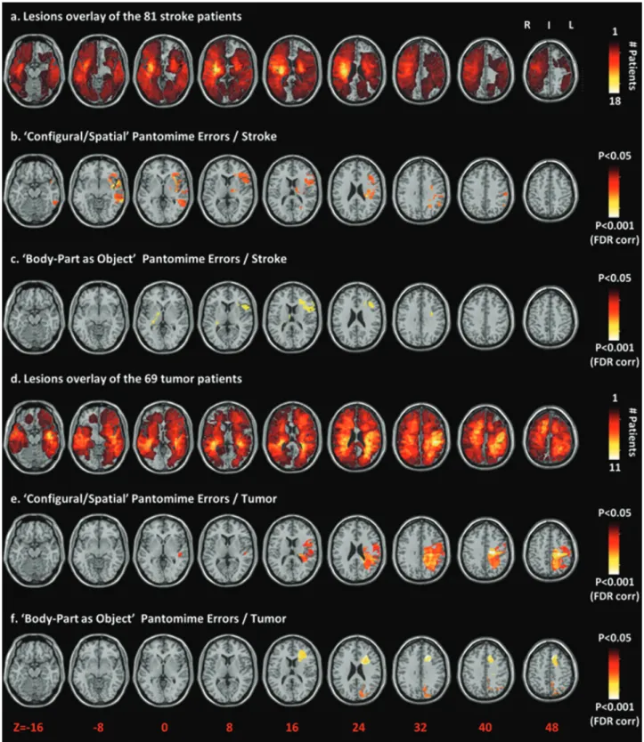 Figure 1. Voxel-based lesion – symptom mapping on the stroke patients and tumor patients separately shows the relationship between performance in pantomime and brain lesions