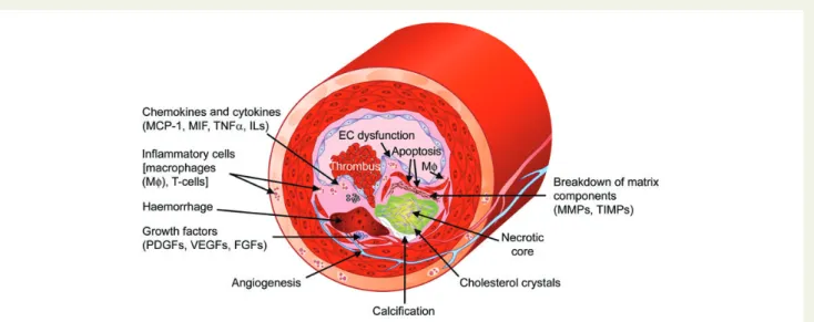 Figure 1 Cross-sectioned coronary artery showing a ruptured thin-cap fibroatheroma. The fibrous cap is very thin near the rupture site (between arrows) and a non-obstructive mural  throm-bus (asterisks) is bordering the gap in the disrupted cap