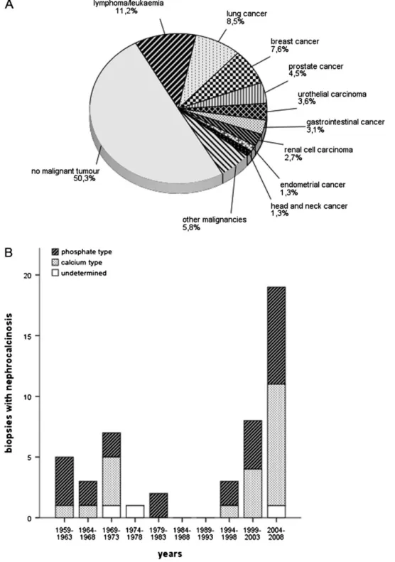Fig. 1. Frequency of nephrocalcinosis. (A) Autopsy cases: 111 of 223 (49.7%) cases of nephrocalcinosis were associated with malignant tumours.