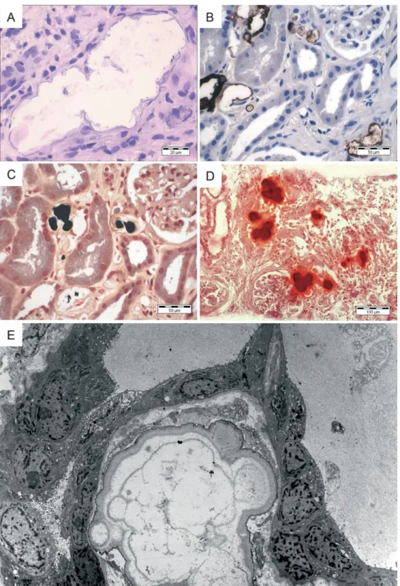 Fig. 3. Characteristics of the shell-like calcifications in the phosphate type of nephrocalcinosis after intake of sodium phosphate bowel purgatives before colonoscopy: (A) Shell-like calcifications (H&amp;E, 3400, scale bar 20 lm)