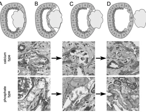 Fig. 5. Hypothetical mechanism of migration of larger intratubular calcifications illustrated schematically (first row) and with examples of calcium type (second row) and phosphate type (third row) calcifications (PAS stain, 3400): Initially, the intratubu