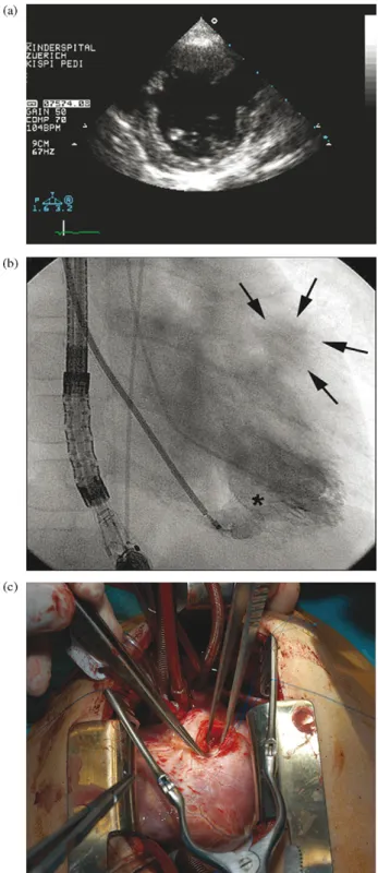 Fig. 1. (a) Parasternal short axis view of 2D-transthoracic echocardiogram revealing the VSD (*) and the pseudoaneurysm of the LV free wall (arrows)