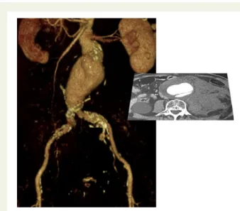 Figure 1 Ruptured juxtarenal aneurysm with a very short neck (,5 mm), ruling out conventional endovascular aortic repair (EVAR)