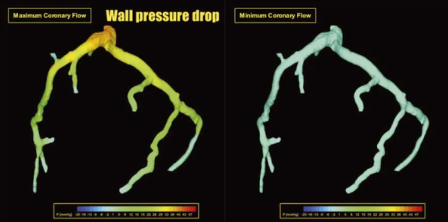Fig. 5. Wall pressure drop: at maximum and minimum coronary flow.