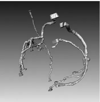 Fig. 8. Post CABG graft coronary geometry acquired using multislice CT scanner.