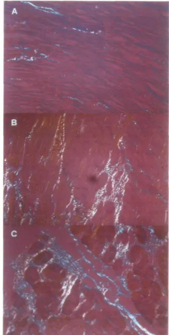 Figure 1 Photomicrographs (magnification x 300, and repro- repro-duced here at 80%) showing the different patterns of collagen network in controls, males and females with aortic stenosis.