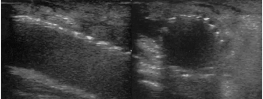 Fig. 1. TTE longitudinal image (left) of the SC inserted with its proximal end inside the IVC and a cross-sectional view in situ (right).