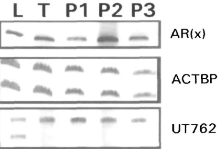 Figure 2. Representative photograph of the gels taken under normal light after staining with a (NO3)Ag method, showing microsatellite alterations at the UT762 marker in lymphocyte (L), tumor (T) and plasma (P) DNA of patient # 11