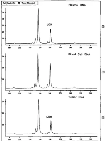Figure 4. Sequencing analysis in plasma DNA (B) of patient #29 shows a nucleotide change at codon 273 (C to G) in the direct sequencing in exon 8 of the TP53 gene
