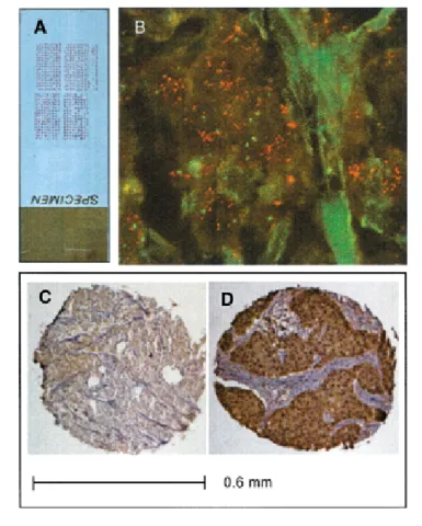 Fig. 3. Analysis of ribosomal protein S6 kinase (S6K) amplification and ex- ex-pression in primary breast tumors