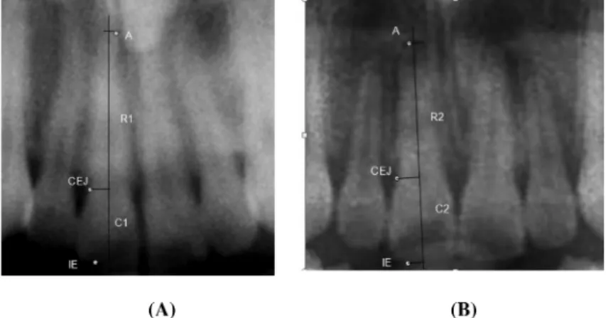 Figure 4  Cropped panoramic radiographs (pre-treatment and post-treatment) of the same patient