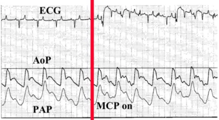 Fig. 3. Arterial pressure curb before and during MCP. Incremental pressure in the diastolic notch is irrelevant.