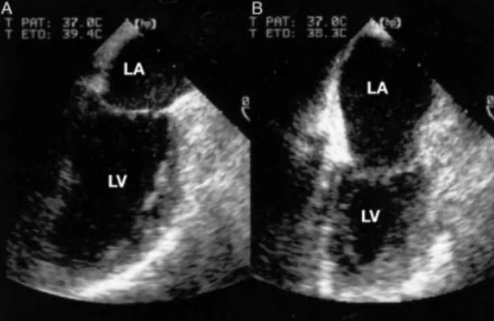 Fig 1 Changes in volume of the left atrium and the left ventricle during heart verticalization