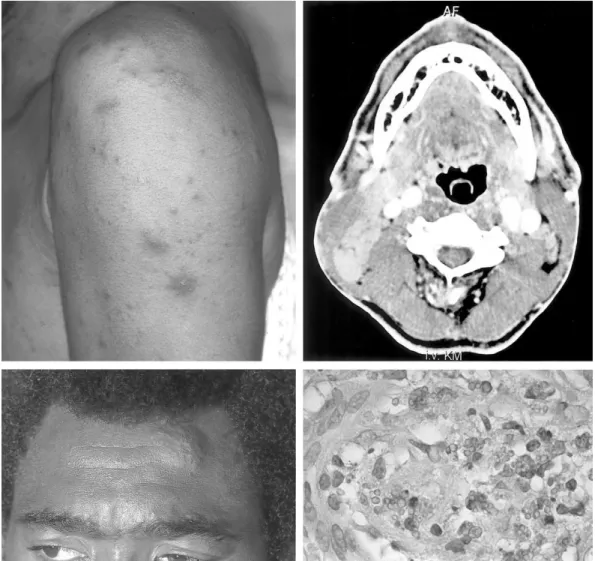 Figure 1. Upper left, Photograph showing skin lesions on arm and shoulder of patient. Upper right, CT scan of neck revealing multiple enlarged lymph nodes