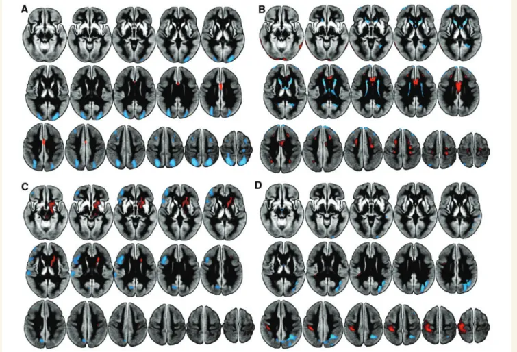 Table 2 presents the area under the curve from receiver operating characteristic analysis of the characteristic Parkinson’s disease-related pattern scores, the individual principal component scores and global grey matter perfusion