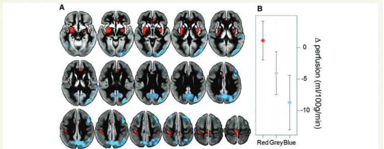 Figure 2B shows the difference in mean absolute perfusion between the Parkinson’s disease and control groups in the three investigated regions (Fig