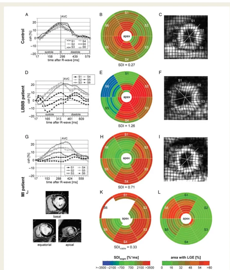 Figure 5 Representative 3D tagging results from a control (A– C), a left bundle branch block patient (D –F ), and a myocardial infarction patient (G– L)