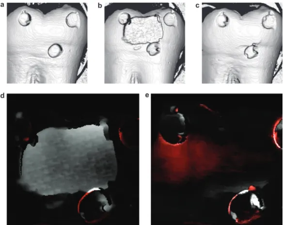 Figure 1   Images at baseline (T0). (a), after bracket removal (T1) (b) with a clearly visible resin remnant, after clean-up  (c) and differences after overlapping baseline T0 and T1 (d)