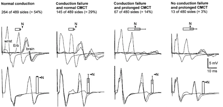 Fig. 7 Recordings from four patients, exemplifying the four types of conduction findings detected by the use of conventional MEP (providing the CMCT) and the TST (providing a measure of conduction failure)