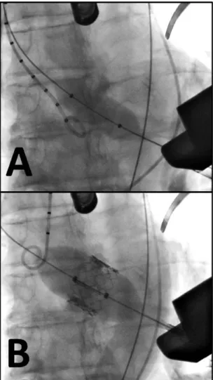 Fig. 1. Fluoroscopy views taken during a transapical TAVI. The balloon aortic valvuloplasty (A) is performed immediately before the stent-valve  implanta-tion (B).